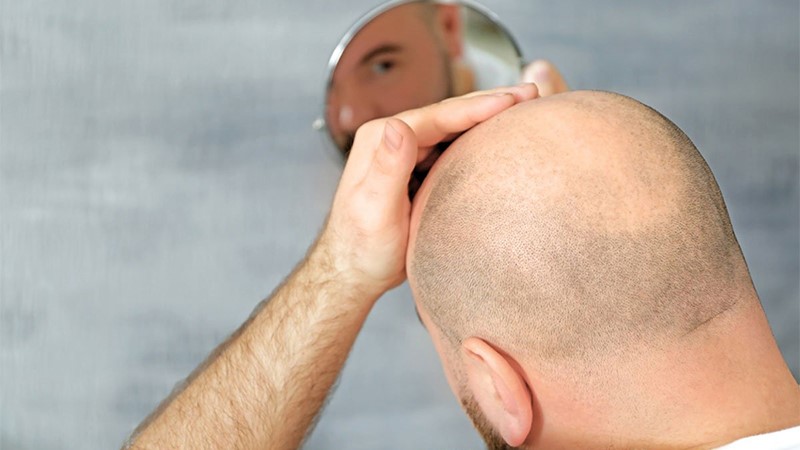 بهترین روش درمان ریزش موی سر