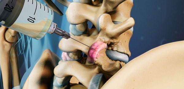 درمان درگیری مفاصل فاست در گردن و کمر با روش های نوین طب فیزیکی