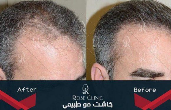نکات مهم در کاشت مو