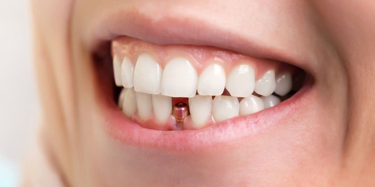 ایمپلنت دندان جلو چیست؟