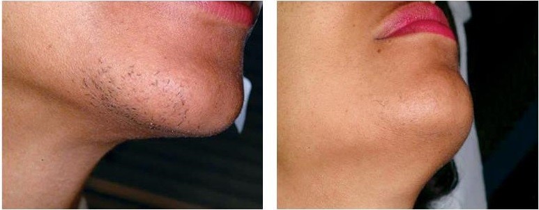 تزریق ژل لب طبیعی در کلینیک پوست و مو رز