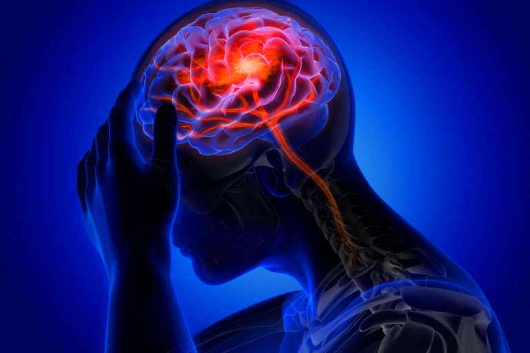 درباره ارتباط بین کویید -19 و سکته مغزی چه باید بدانیم؟