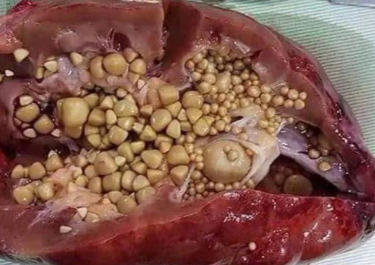 درمان سنگ کلیه چگونه است و کلیه چه زمانی سنگ ساز می شود؟