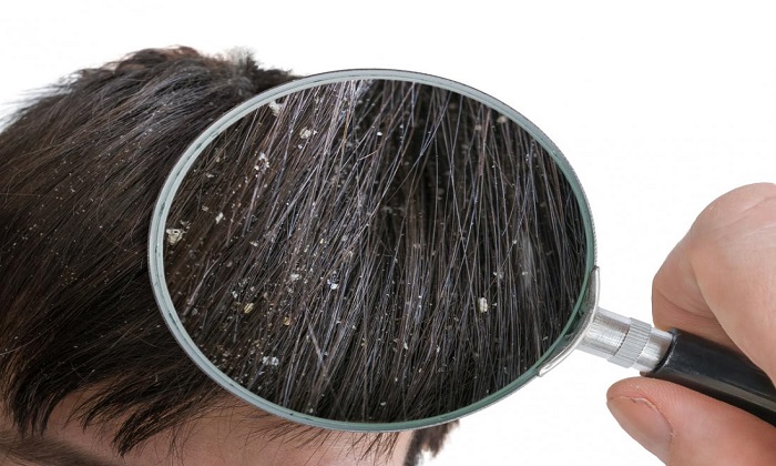 5 دلیل بروز شوره سر بی ارتباط با خشکی پوست
