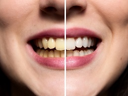 عواملی که موجب تغییر رنگ دندان می شود روش های اصولی برای سفید کردن دندان