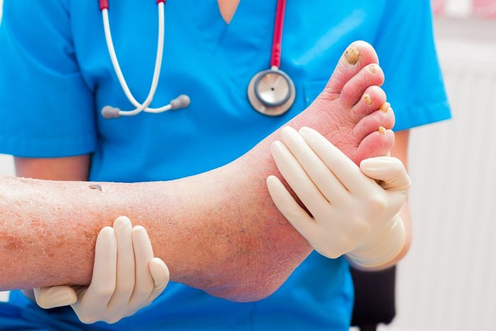 مراقبت های طلایی برای درمان زخم پای دیابتی
