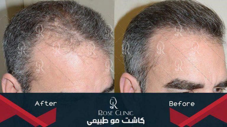 نکات مهم در کاشت مو