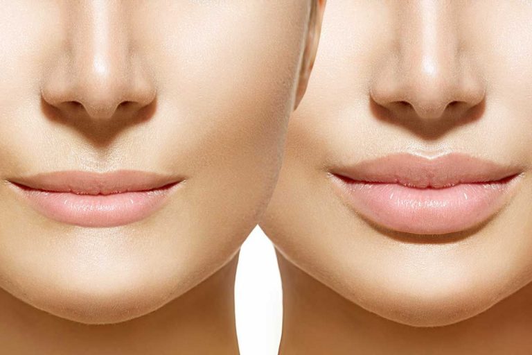 پاسخ به 12 سوال تزریق ژل لب از زبان دکتر نیلفروش زاده