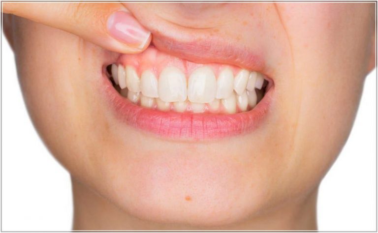 چگونه از لثه‌هایمان به درستی مراقبت کنیم؟